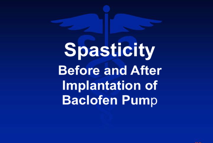 Spasticity Before and After Implantation of Baclofen Pump